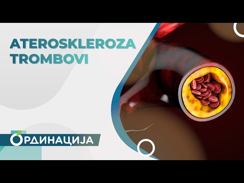 Kako prepoznati i prevazići aterosklerozu i trombove | RTS Ordinacija