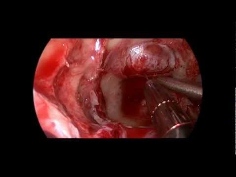 What Pituitary Adenoma