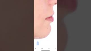 Face Pimple Remover Photo editing iPhone App￼ screenshot 2