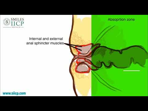 Learn How To Insert Anal Suppository - SMILES Gastroenterology