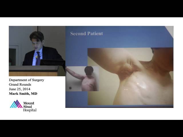 Vascularized Lymph Node Transfer: An Evolving Treatment for Post-Surgical Lymphedema