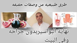 أنواع البواسير وعلاجها نهائياً من الطبيعه