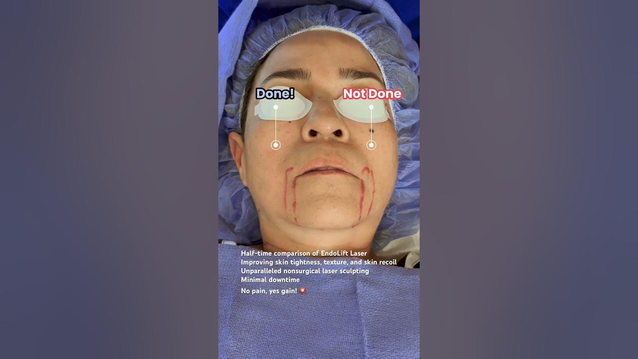 Endolift Laser, Jawline Contouring Before and After PCH MedSpa, Orange County YouTube