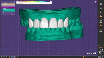Exocad Mockup Design on Tooth 13 - 23 ( 6 Unit )
