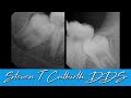 Improve Your Wisdom Teeth Extraction Technique - Dental Minute with Steven T. Cutbirth, DDS