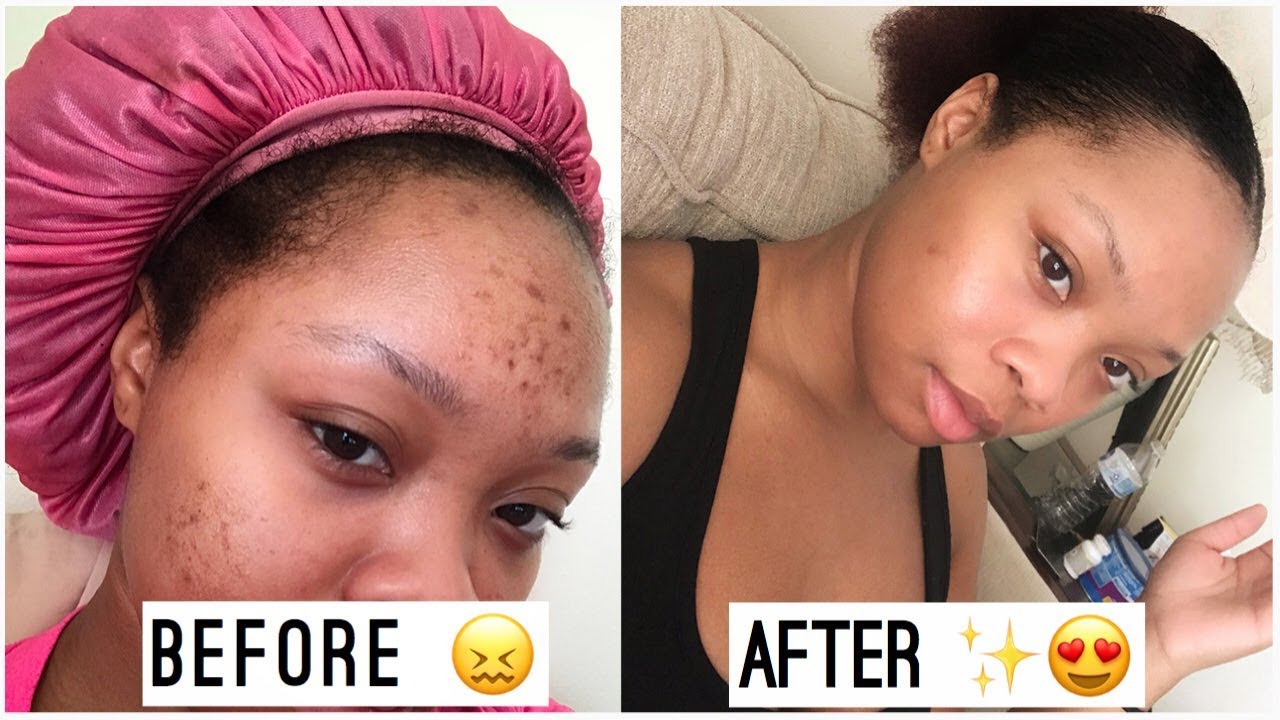I Got Rid of My Dark Spots In less than a WEEK!!! - YouTube