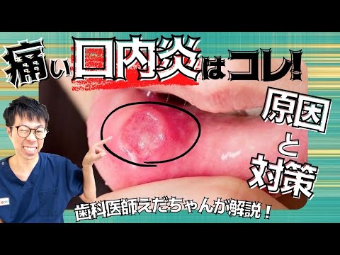 【歯科医が解説！口内炎にはこれだ！】早く治す方法お伝えします！