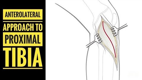 Anterolateral Approach to Proximal Tibia