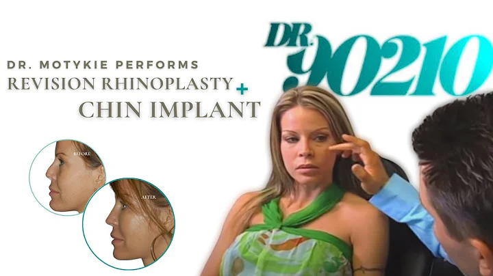DR.90210: CHIN IMPLANT + REVISION RHINOPLASTY BY D...