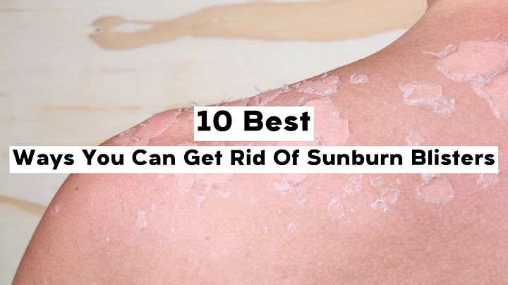 How to get rid of sunburn blisters