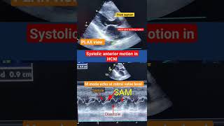Download Lagu Systolic Anterior motion (SAM) of mitral valve in HCM l Hypertrophic cardiomyopathy #hcm #shorts MP3