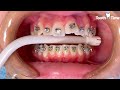 How they put Braces on - 13 years old patient - Tooth Time Family Dentistry New Braunfels Texas