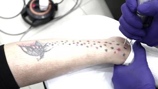 The Process Of Removing A Permanent Tattoo Using A Laser At Rosidis Eyebrow Studio