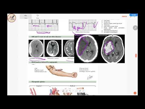 STROKE Lengkap - Klasifikasi, Patofisiologi, Skor Siriraj, Gajah Mada, Latihan Soal UKMPPD