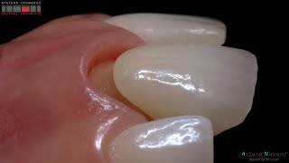 BOPT layered zirconia full crown by cdt Arturo Navoni. Intra Oral Scanner Trios 3 by 3Shape