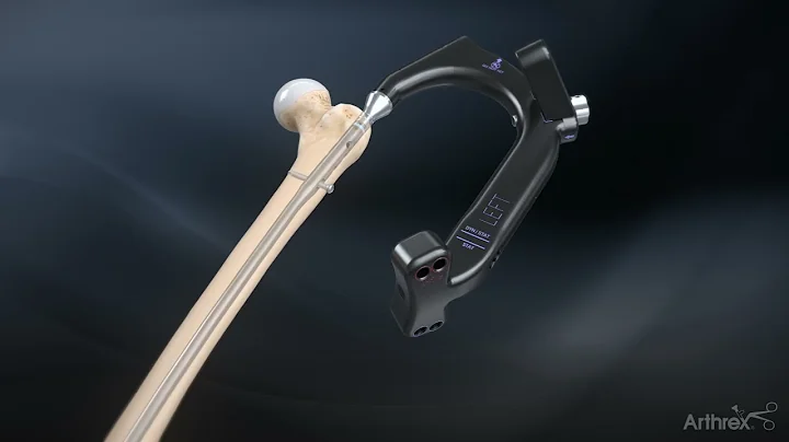 Antegrade Femoral Nail System Surgical Technique
