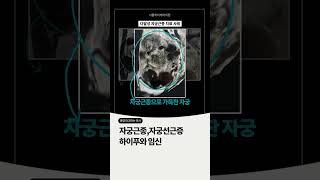 자궁선근증으로 4번의 인공수정 실패, 하이푸 치료하고 나서 #자궁선근증 #임신