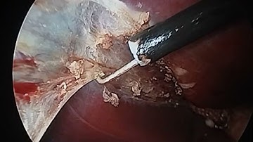 hook dissection for gallbladder dissection from liver bed @drvikrantsinghchandail