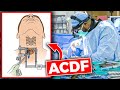 Anterior Cervical Discectomy and Fusion (ACDF)