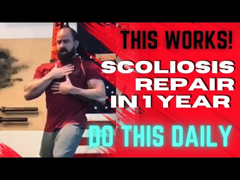 SCOLIOSIS REPAIR (this