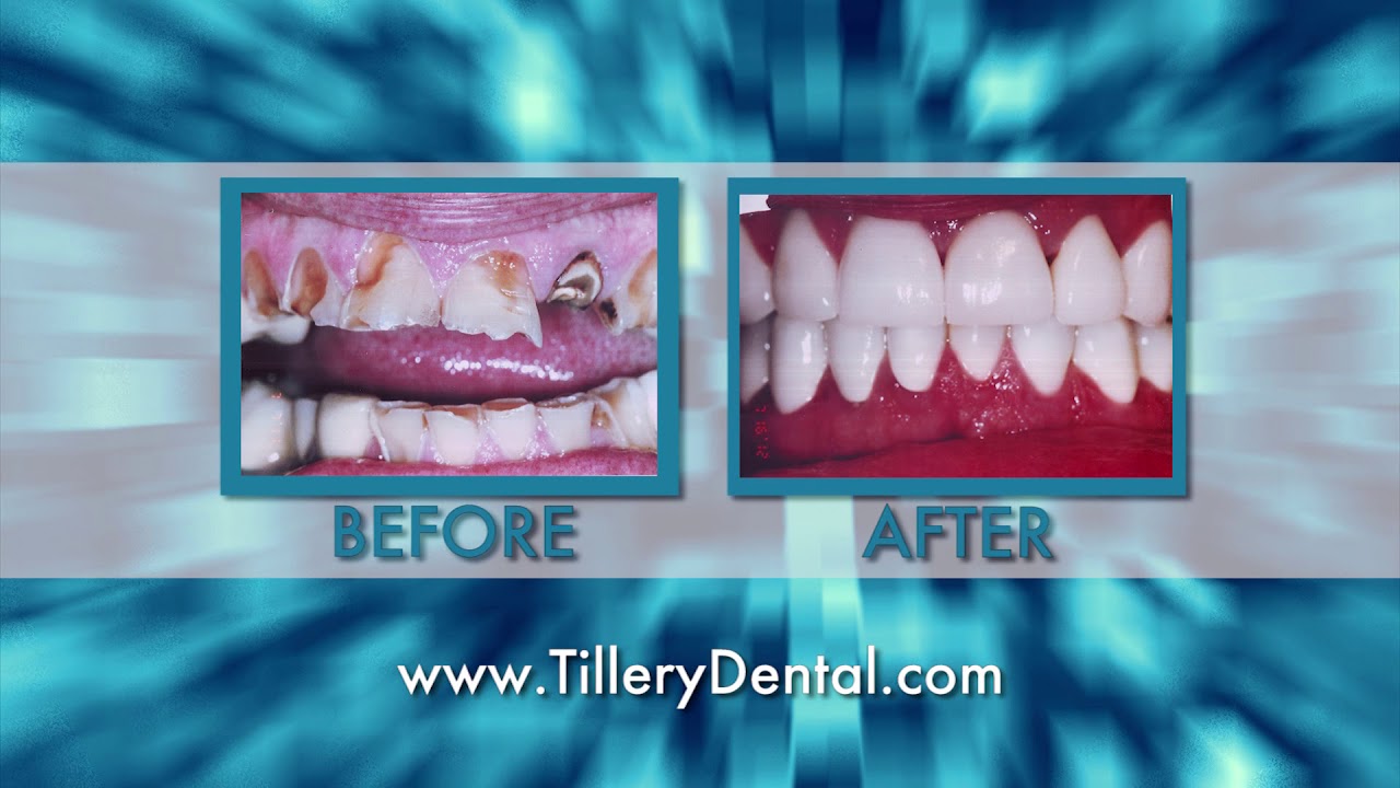 WDAM Commercial Tillery Dental of Laurel Implant JAN18 YouTube