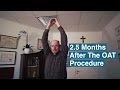 2.5 Months After His Frozen Shoulder Cure. Here are The Results!