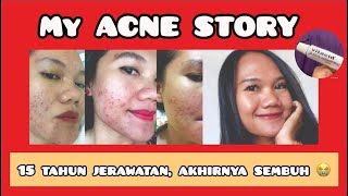 MY ACNE STORY (BERJUANG MENYEMBUHKAN JERAWAT SELAMA 15 TAHUN) - CUMA DENGAN OBAT AMPUH INI!