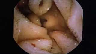 Colonoscopy-Who Really Needs It?