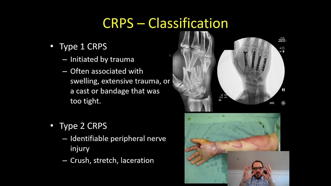 complex-regional-pain-syndrome-crps-dr-apel-2-5-2023-youtube