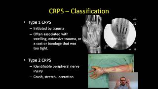 Complex Regional Pain Syndrome (CRPS)  Dr Apel 2/5/2023