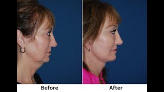 Segmental Endoscopic Brow Lift, SOOF lift blepharoplasty, a Deep Plane Facelift with SMG Shave.