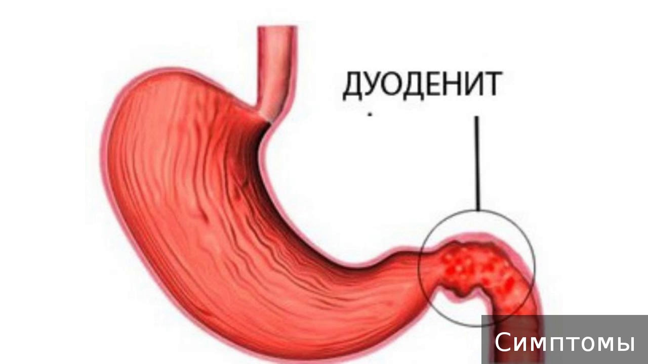 Очаговый пищевод