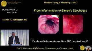Esophageal adenocarcinoma: Does ARS have an impact?