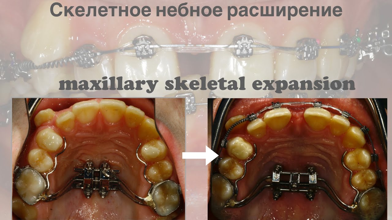 MSE/MARPE. Скелетное небное расширение с опорой на микроимпланты