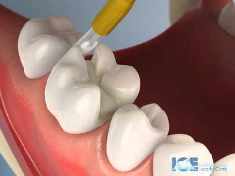تصویری: اینله دندانی چیست؟