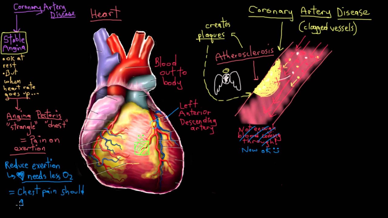 Khan Academy - What is Coronary Artery Disease? - YouTube