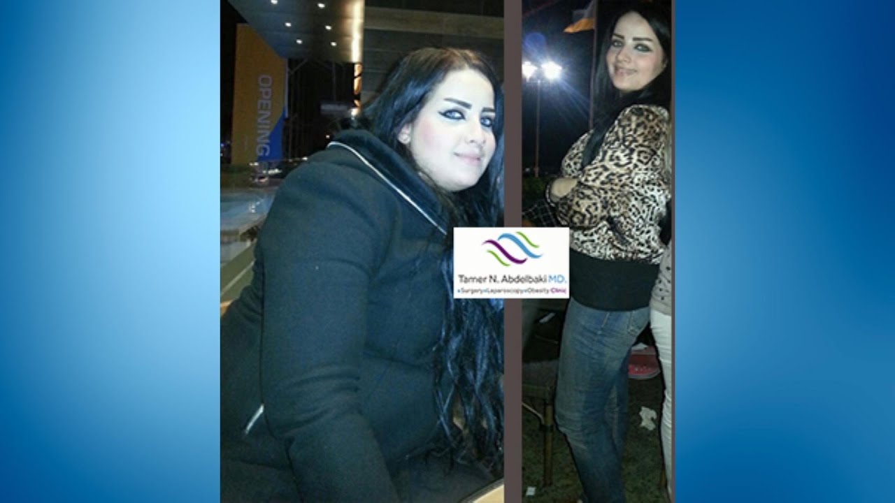 قصص نجاح: الحياة بعد جراحات السمنة - د تامر عبدالباقي