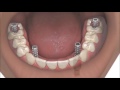 Allon4 dental implants coventry best same day full whole mouth teeth implants at verum dentists