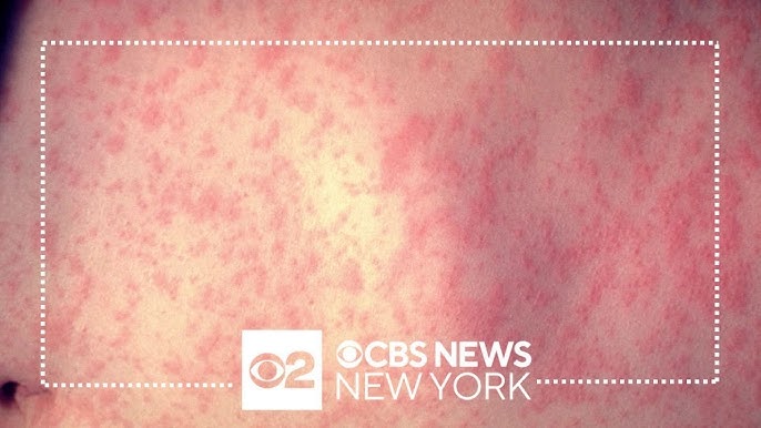 Cdc Nearly 2 Dozen Measles Cases Recorded Across U S Since December