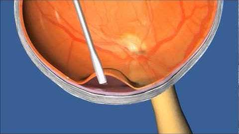 RetinalProsthesis