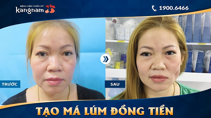 Thẩm mỹ tạo má lúm đồng tiền bao nhiêu tiền