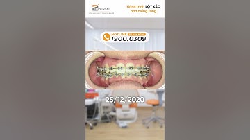 Hành trình LỘT XÁC nhờ niềng răng của Thu Hằng