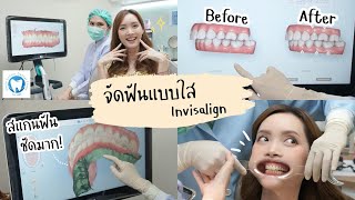 จัดฟันรอบ 3 ให้มันจบที่ Invisalign! แก้ฟันยื่น ฟันซ้อน รูปปาก V และสารพัดปัญหา | Kirari TV