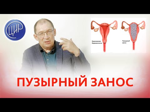 Video: Triploidiya aborta səbəb ola bilərmi?
