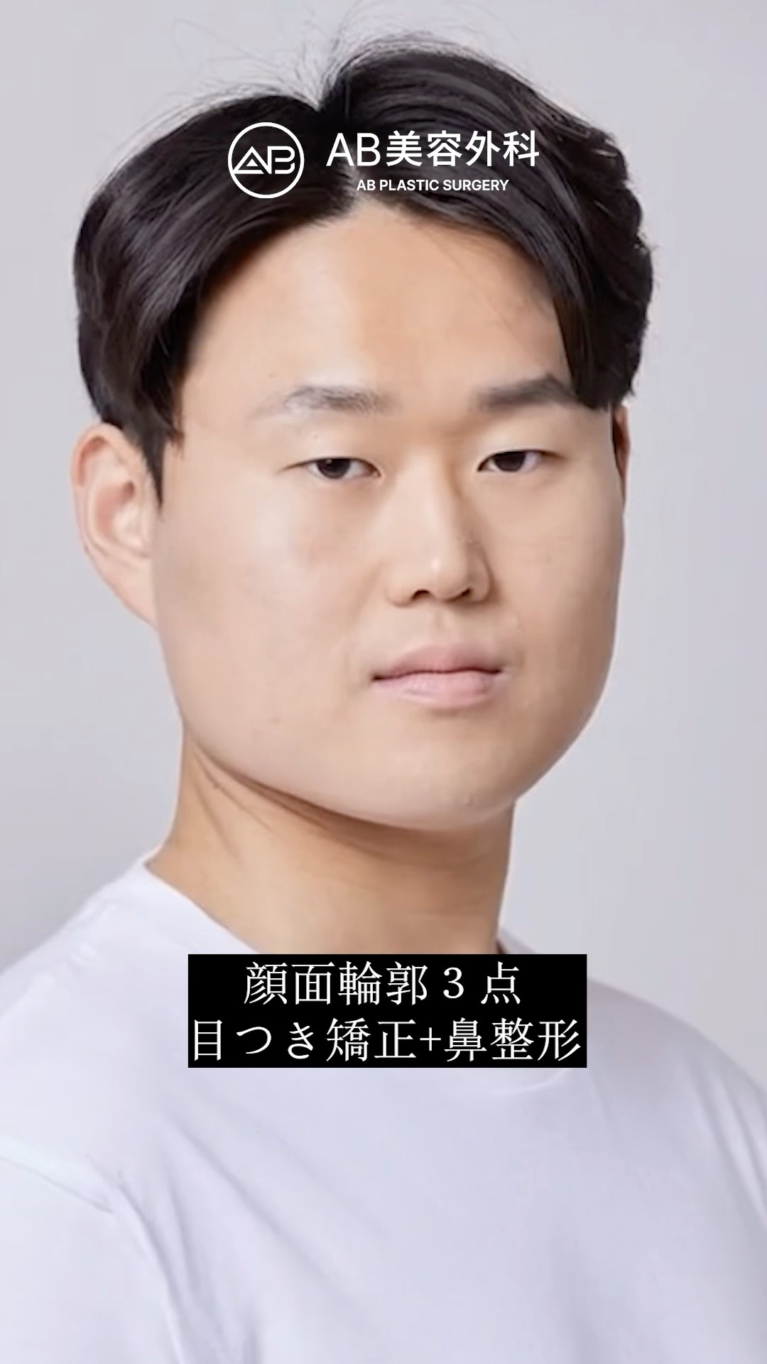 ブサイクからイケメンへ…韓国整形の奇跡！ #shorts