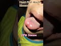 ##🖐️👣😷 Hand Foot Mouth Disease in Kids |# Dr Vivekanand Explains #childcare  hospital ###