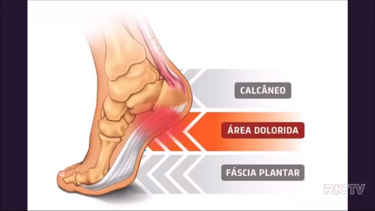 Dor no calcanhar: pode ser fascite plantar. Doctor Feet Podologia