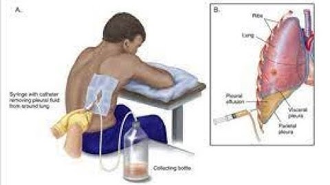 Thoracentesis CPT code - simplify medical coding