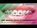 Are braces results permanent? क्या ब्रेसेस हटने के बाद दांत अपनी पुरानी जगह चले जाते हैं? Dr.Srishti