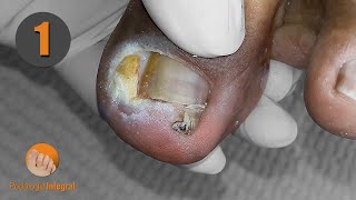 Ingrown toenail & granuloma (1st part) #podologiaintegral